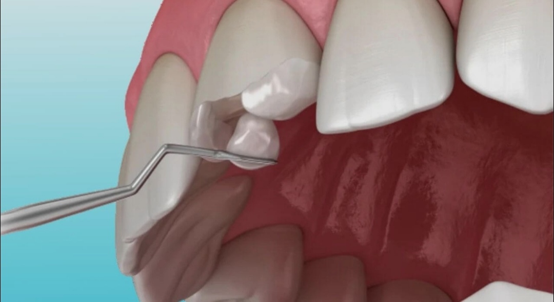 Dental Fillings