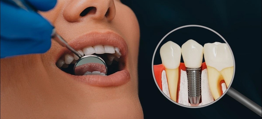 Dental Implants