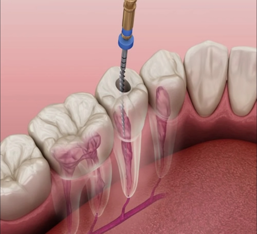 Root Canal Treatment