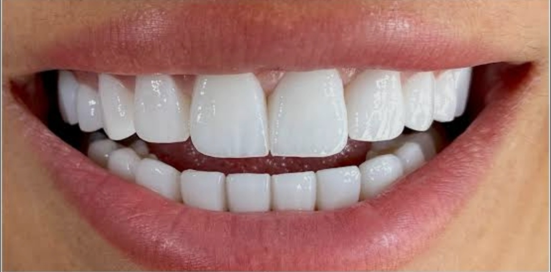 Teeth Whitening