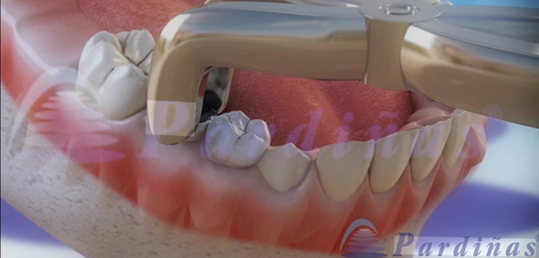 Tooth Extraction